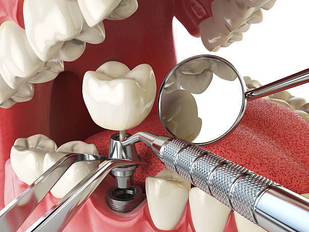 Best Emergency Dentist for Lost Fillings or Crowns in Georgetown, SC